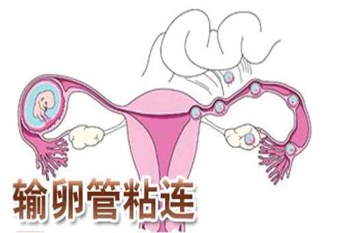 输卵管粘连,是不是难孕了?