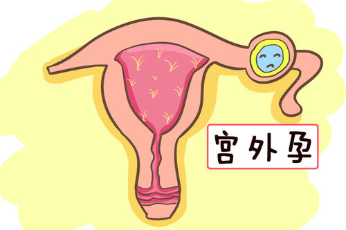 异位妊娠是输卵管妊娠