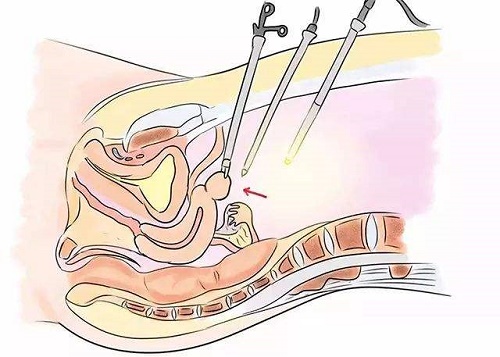 妇科腔镜介绍