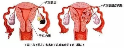 子宫腺肌