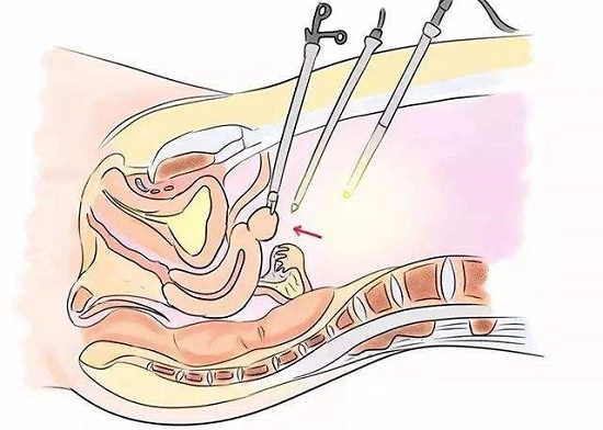 给大家分享一下关于腹腔镜手术的方方面面