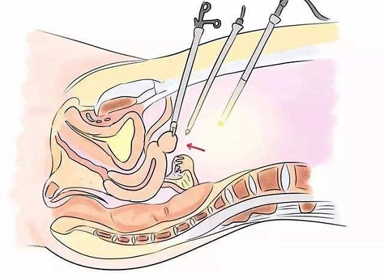 腹腔镜手术