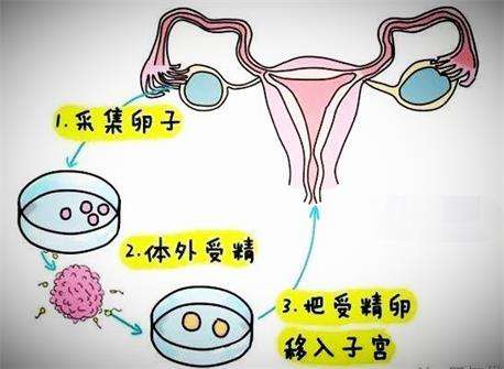 成都西囡妇科医院带你走进“人工授精”常识问题