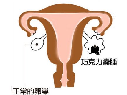 巧克力囊肿的特点