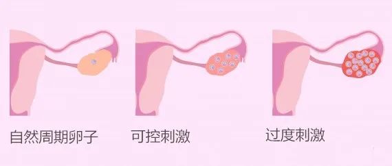 OHSS根据病情分为轻、中、重度,中重度患者需要住院治疗