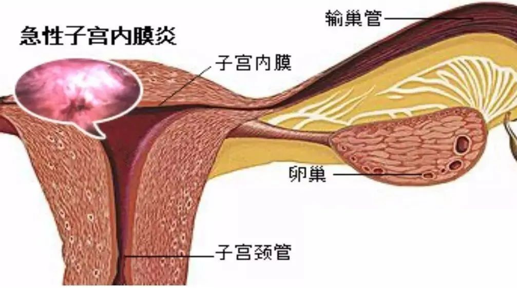 急性子宫内膜炎