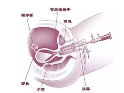 试管婴儿移植手术示意图