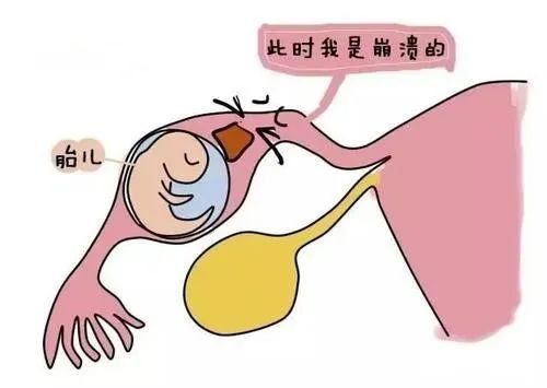 试管婴儿移植后14-28天,持续性出血,伴随一侧或两侧小腹剧烈疼痛,要及时就医,谨防宫外孕的发生